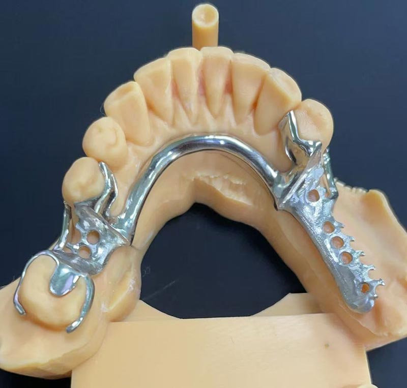 Предимства на кобалтово-хромовата рамка (Co Cr рамка)