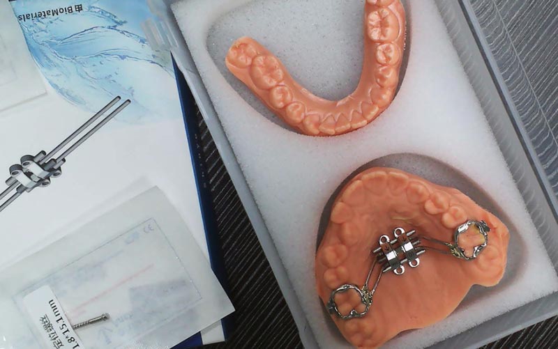 Разберете разширяването на скелета на MSE с WM Dental Lab