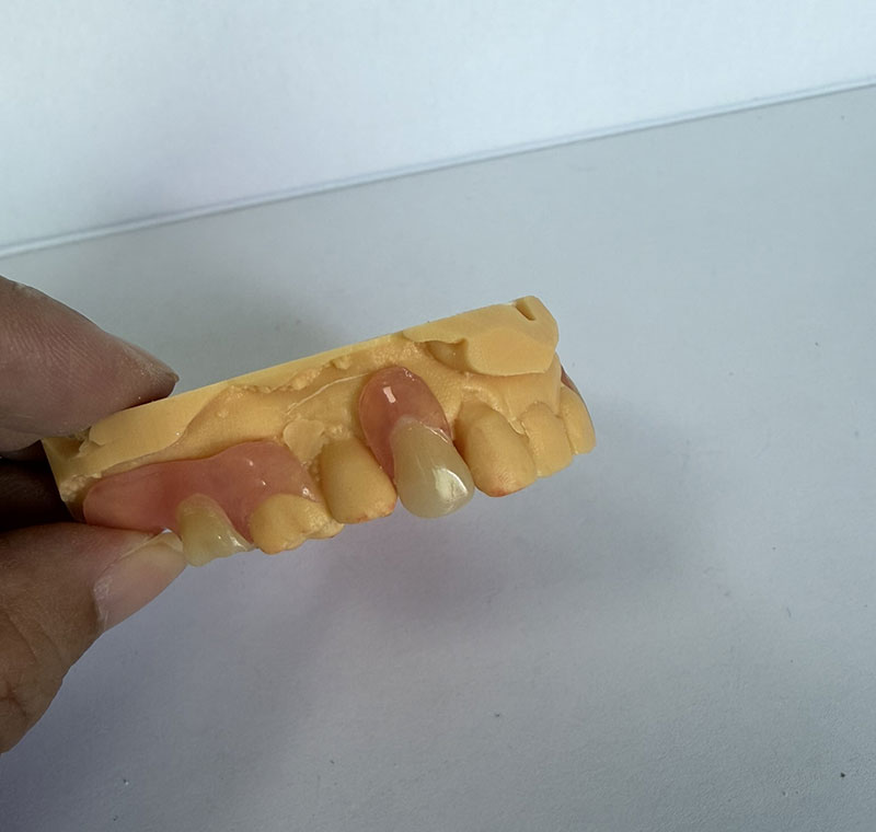 Valplast Partials в WM Dental Lab