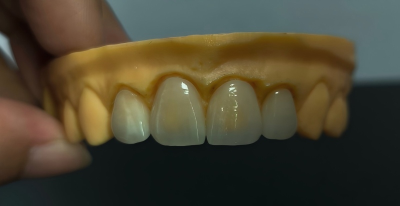 Porcelain Veneers