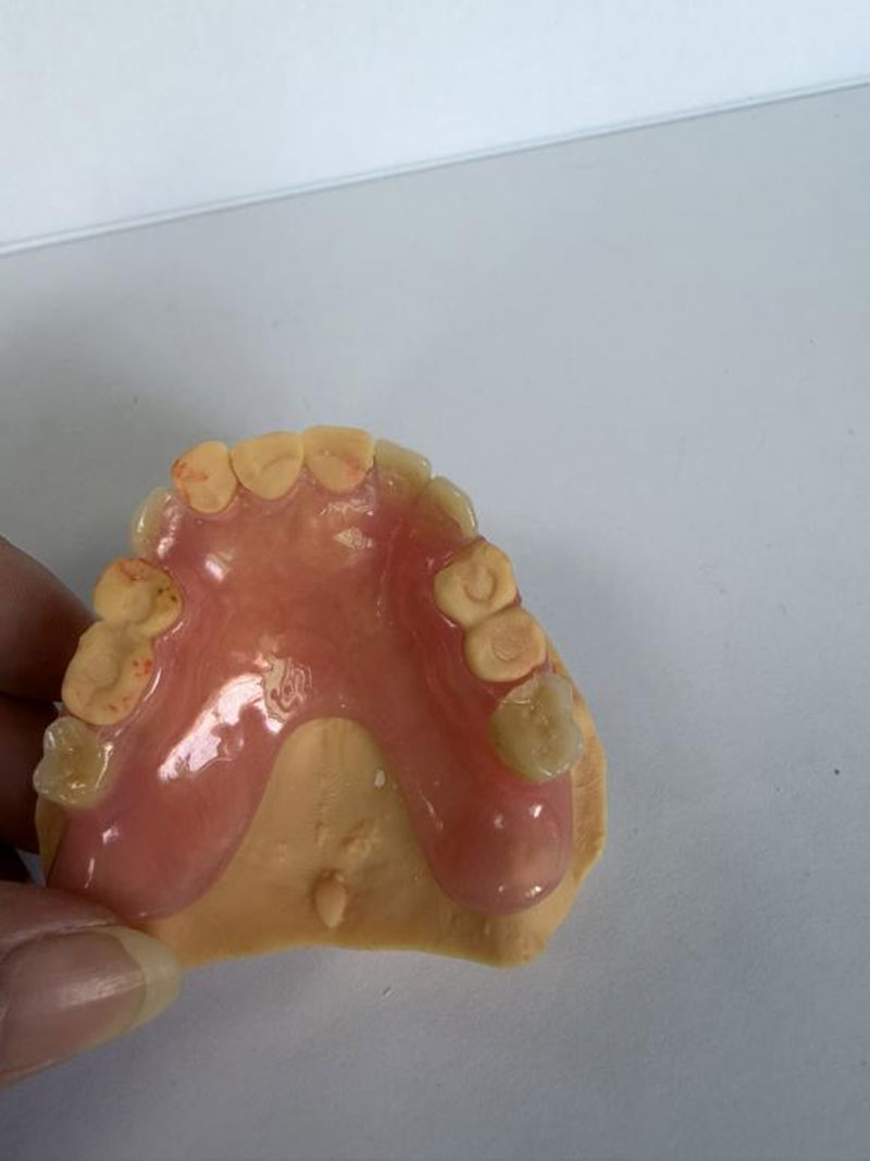Valplast flexible partial denture example - natural aesthetics